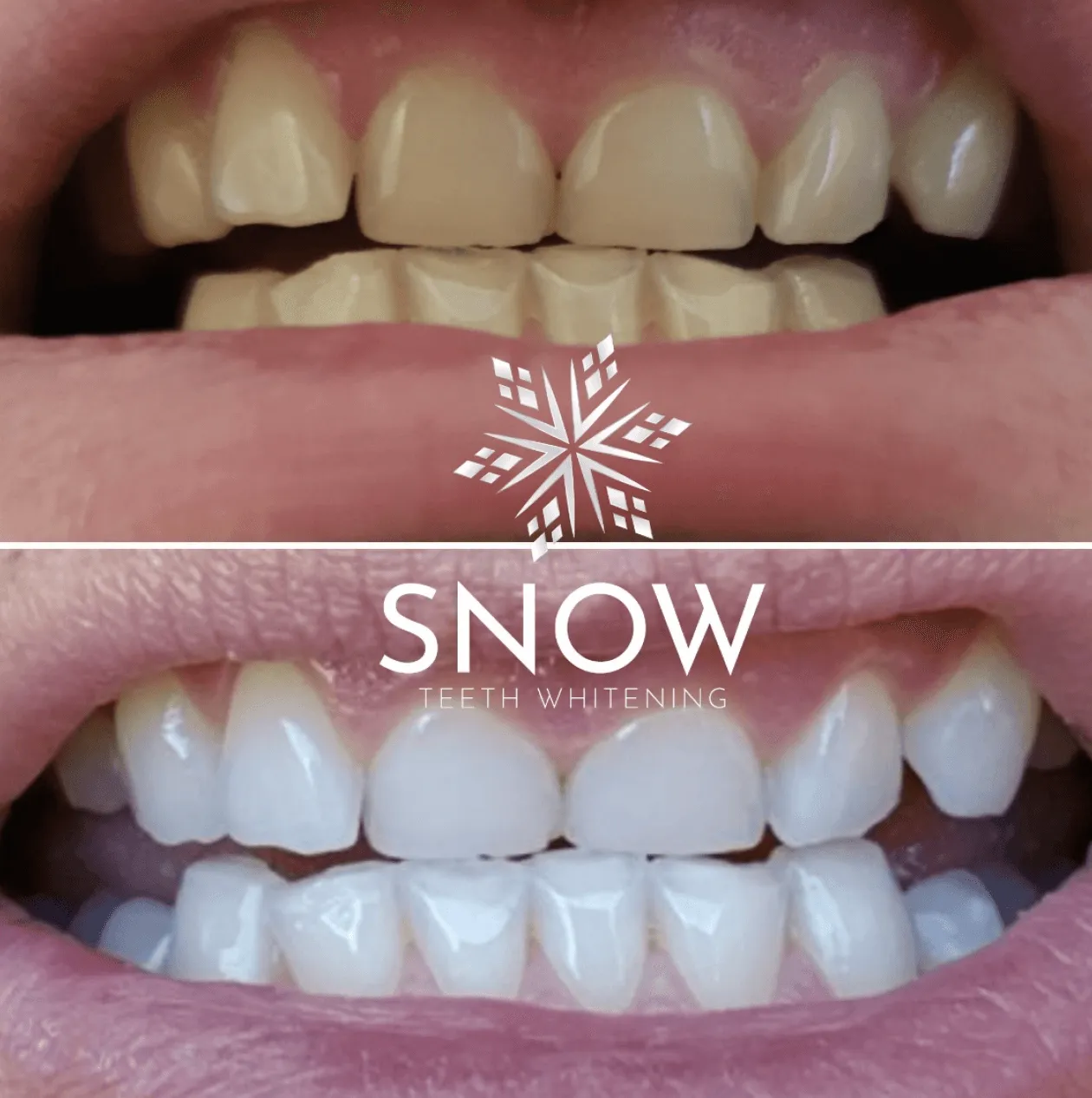 SNOW Teeth Whitening   6-Month Toothpaste Bundle